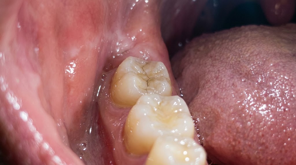 A thin dark line across the top of a back tooth